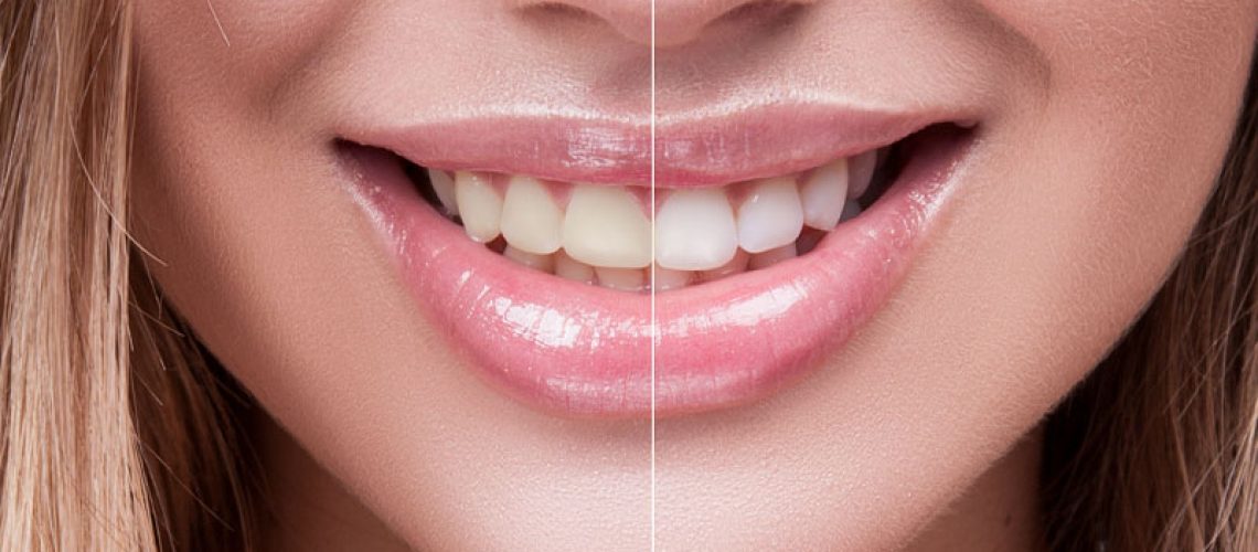 Teeth Whitening Before And After